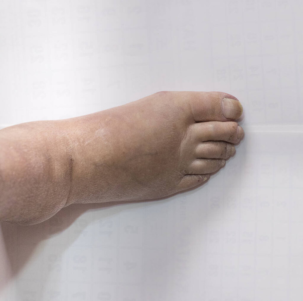 Sharcot Foot