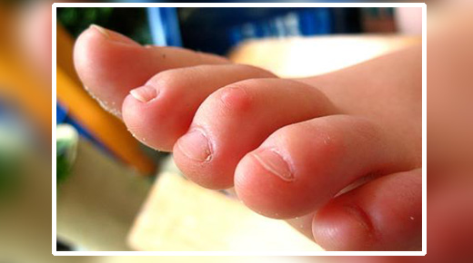 Mallet & Hammer toe